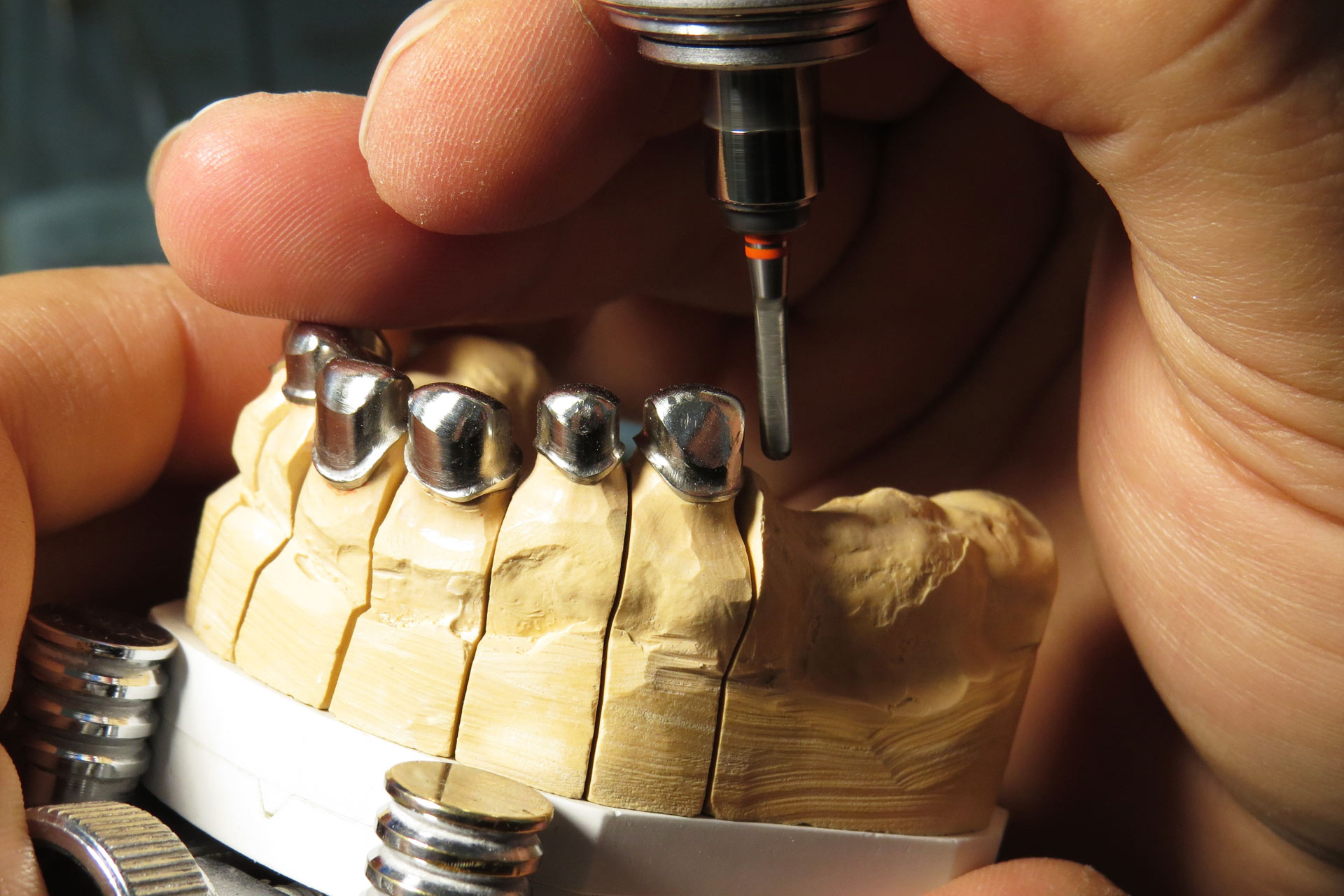 Dentalschmiede Falkensee GbR - Konventionelle und implantatgetragene Kombinationsprothesen
